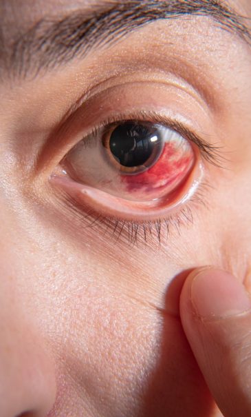 Травма ока крововилив